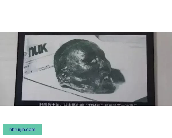 俄13外14外EET出血，背后隐藏着怎样的医学谜团？ 